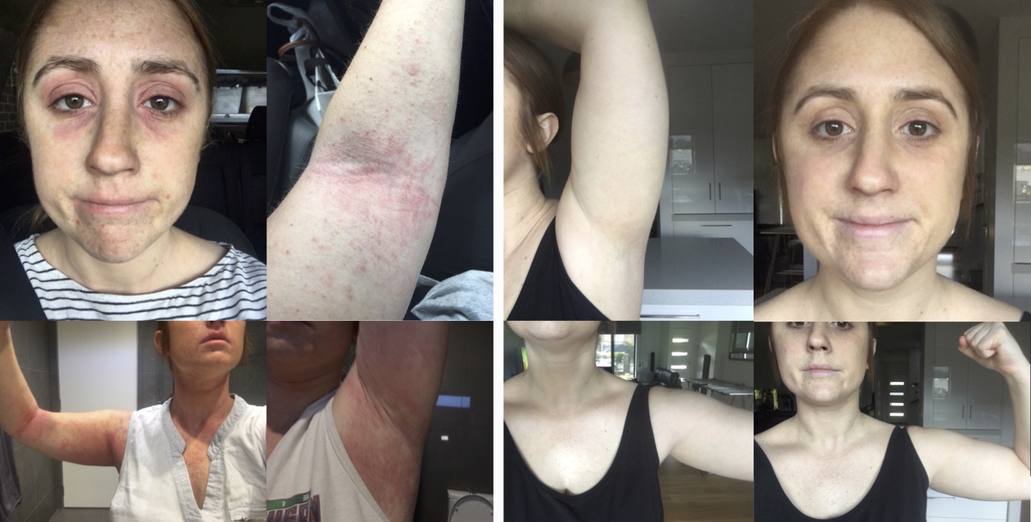 Eczema testimonial