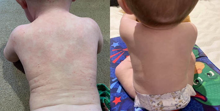 Amazing Eczema Before And Afters Salts Of The Earth 8743